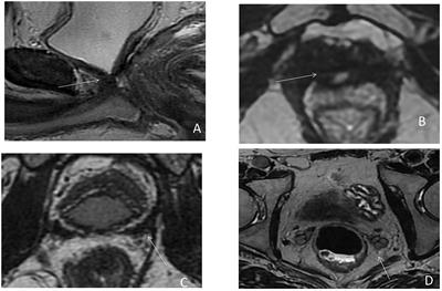 Targeting Local Recurrence After Surgery With MRI Imaging for Prostate Cancer in the Setting of Salvage Radiation Therapy